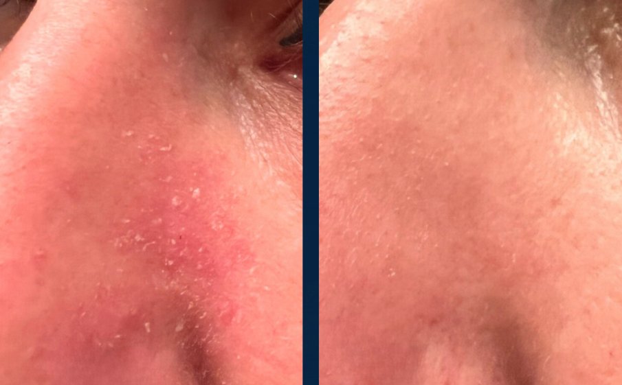 Before and after, red flaking skin beside the nose