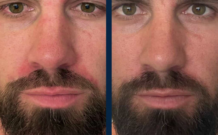 Before and after, redness beside the nose and brows
