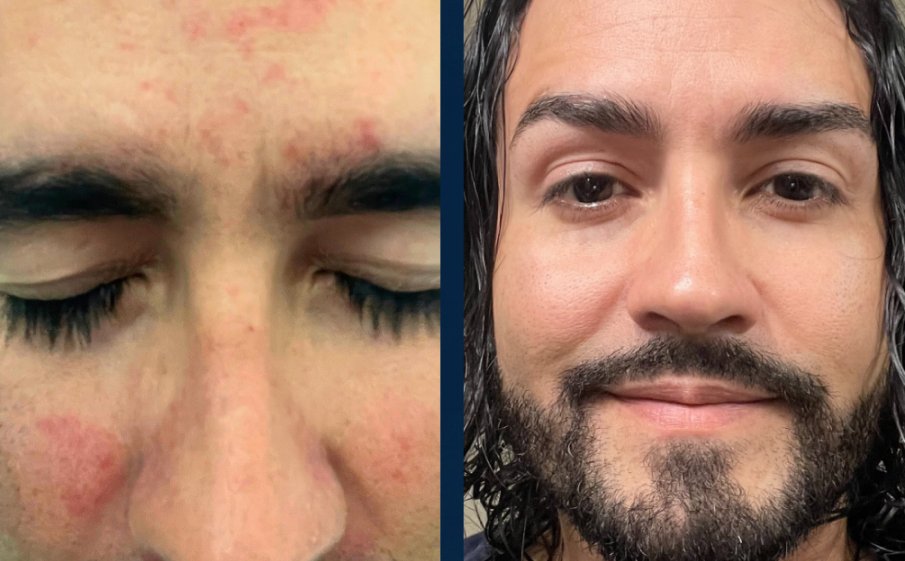Before and after, red spots on the forehead