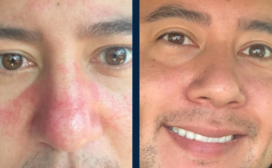 Before and after, red nose and cheeks