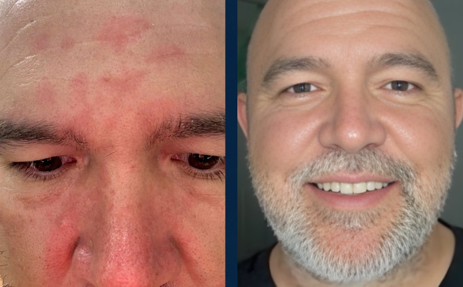 Before and after, forehead and nose redness