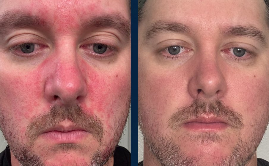 Before and after, red patches on forehead, cheeks and nose