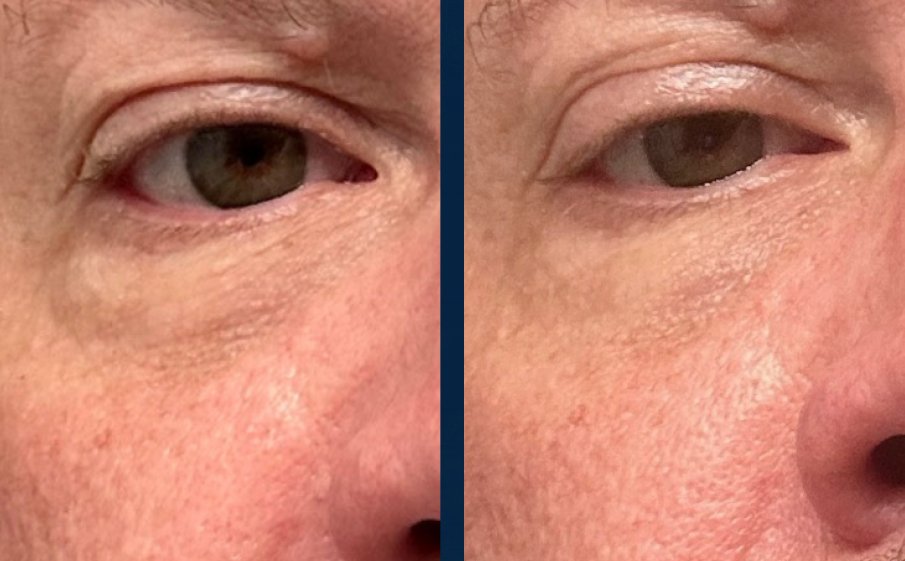Before and after, under-eye puffiness
